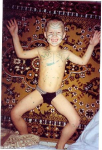 Юра с ветрянкой